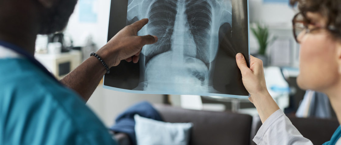 Une révolution silencieuse bouleverse l'oncologie pulmonaire. Tandis que les campagnes anti-tabac portent leurs fruits à travers le monde, une menace inattendue émerge : le cancer du poumon chez les non-fumeurs connaît une progression alarmante, particulièrement en Asie orientale.